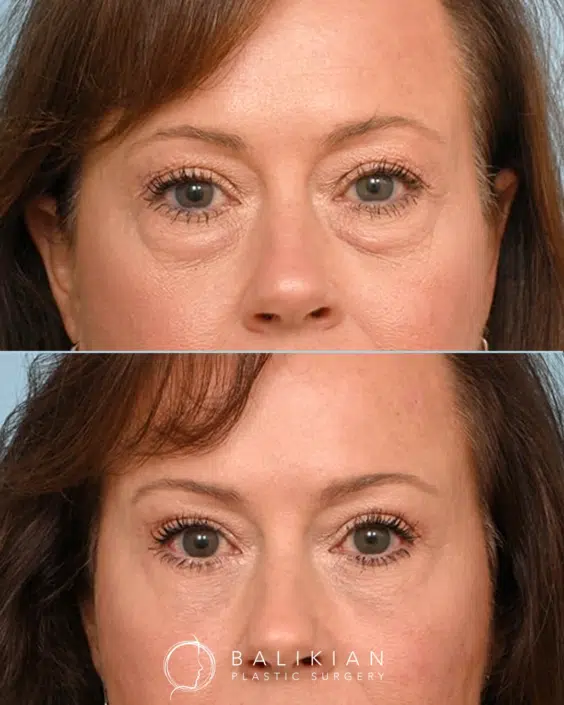 This patient in her 50s was concerned with under-eye hollowness. Upper and lower blepharoplasty with facial fat transfer restored volume and created a softer, more refreshed eye area. Before and after photos of a patient who underwent upper and lower blepharoplasty with facial fat transfer, showing reduced under-eye hollowness and smoother, more youthful eyelid contours.