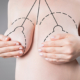 Illustration showing breast reduction surgery markings on a woman’s chest, representing reduction mammoplasty recovery and surgical planning.