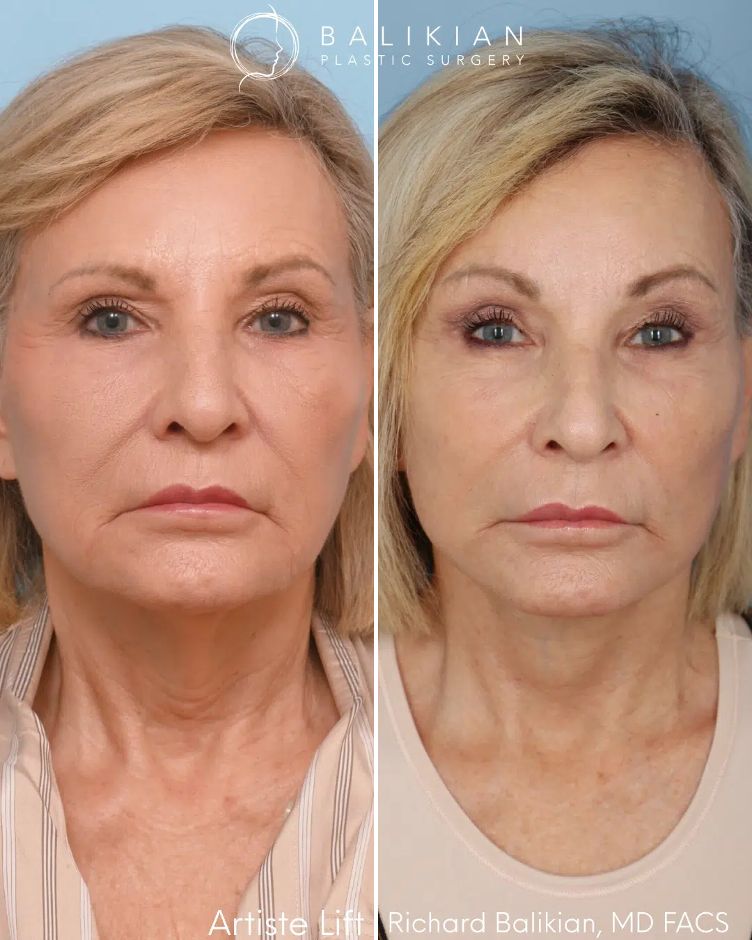 Front view before and after deep plane facelift with brow lift and skin resurfacing.
