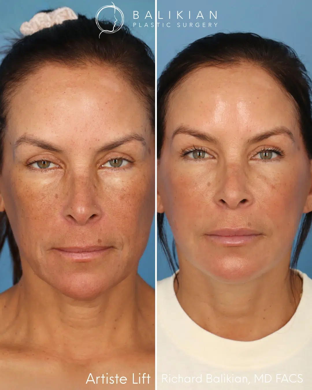Front view before and after preservation deep plane facelift with neck lift.