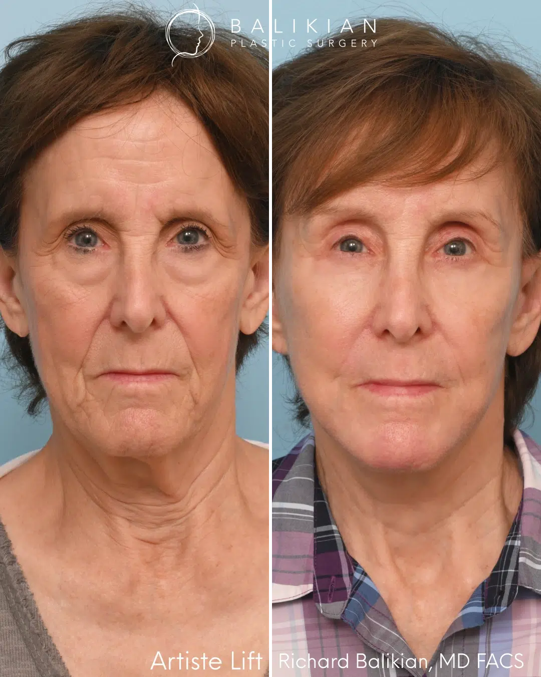 Front view before and after preservation deep plane facelift with brow and eyelid rejuvenation.