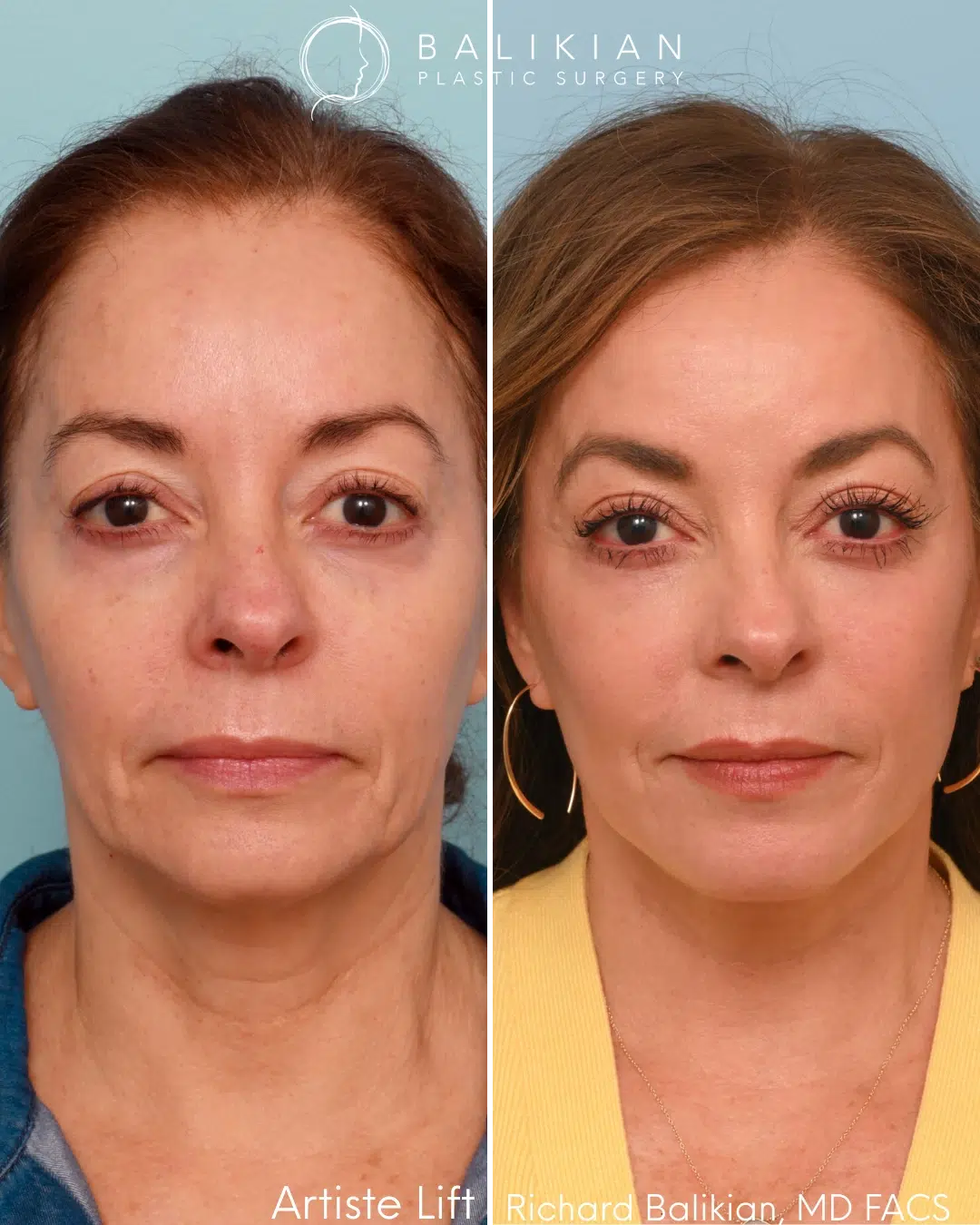 Front view before and after deep plane facelift with eye area rejuvenation.