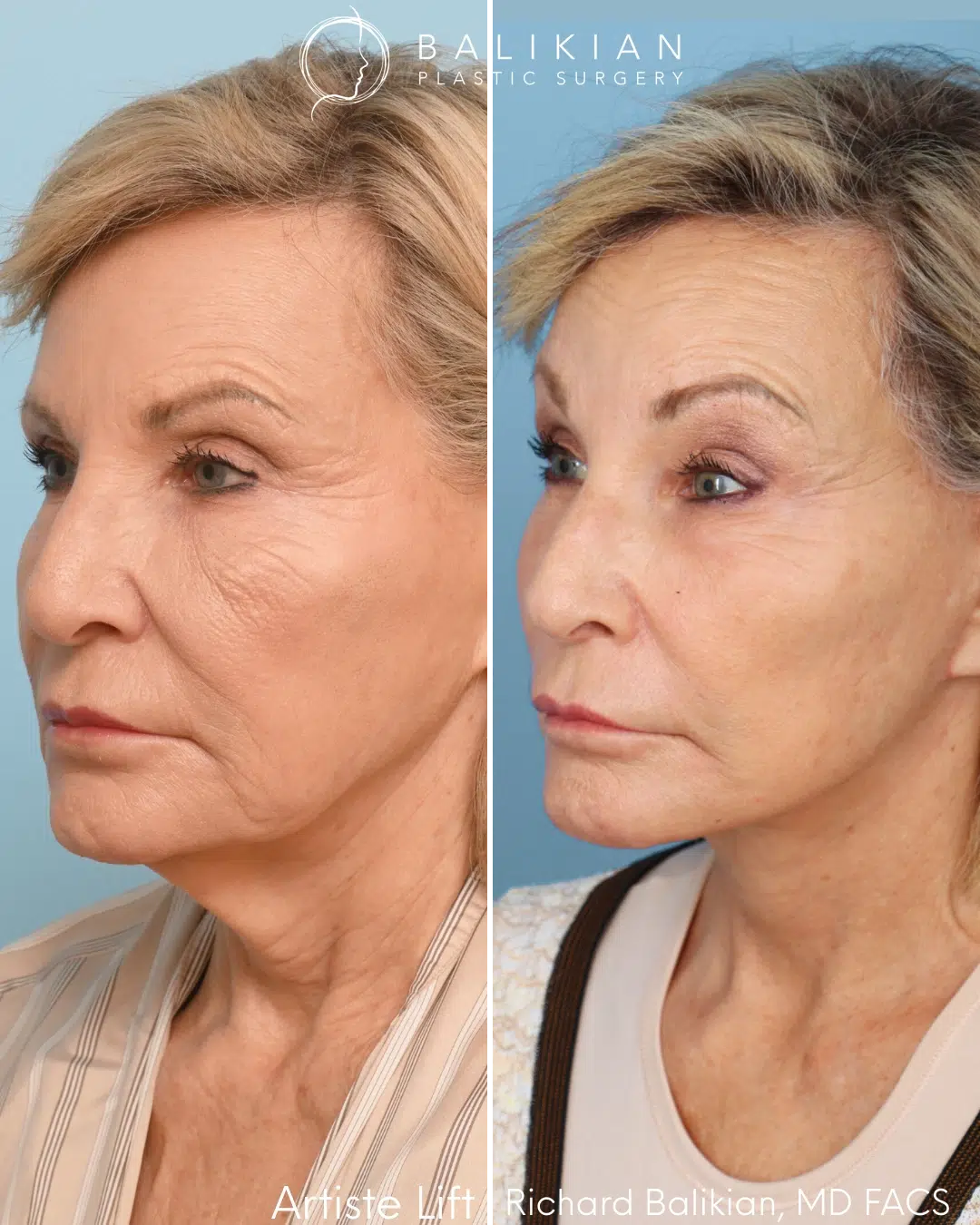 Oblique view before and after comprehensive facial rejuvenation.