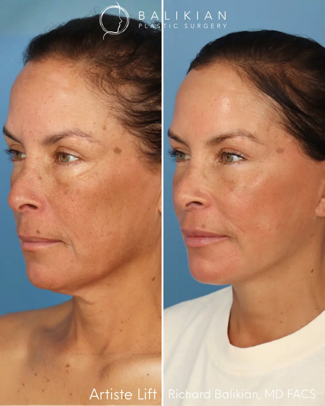 Oblique view before and after facial rejuvenation.
