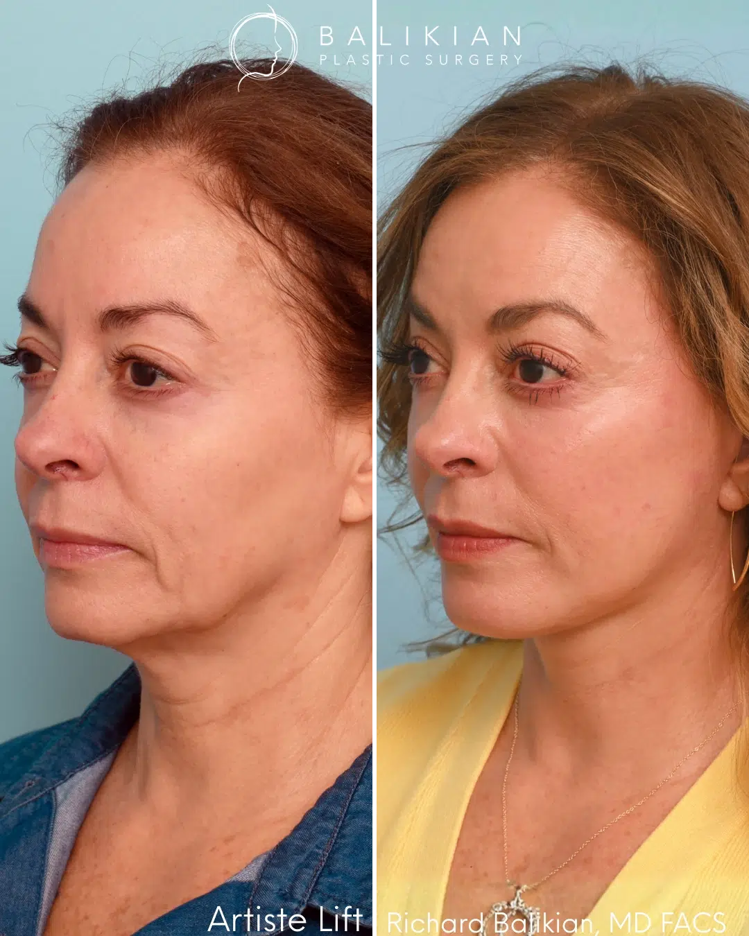 Oblique view before and after facial rejuvenation surgery.