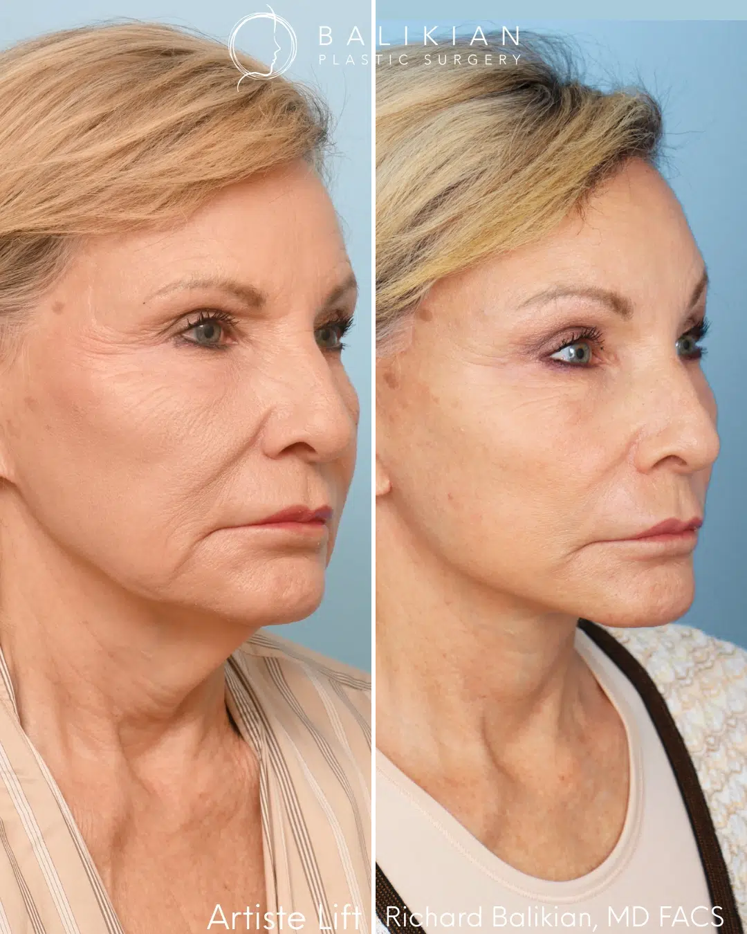 Oblique view before and after comprehensive facial rejuvenation.