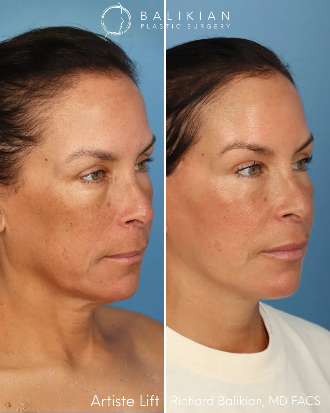 Oblique view before and after facial rejuvenation.