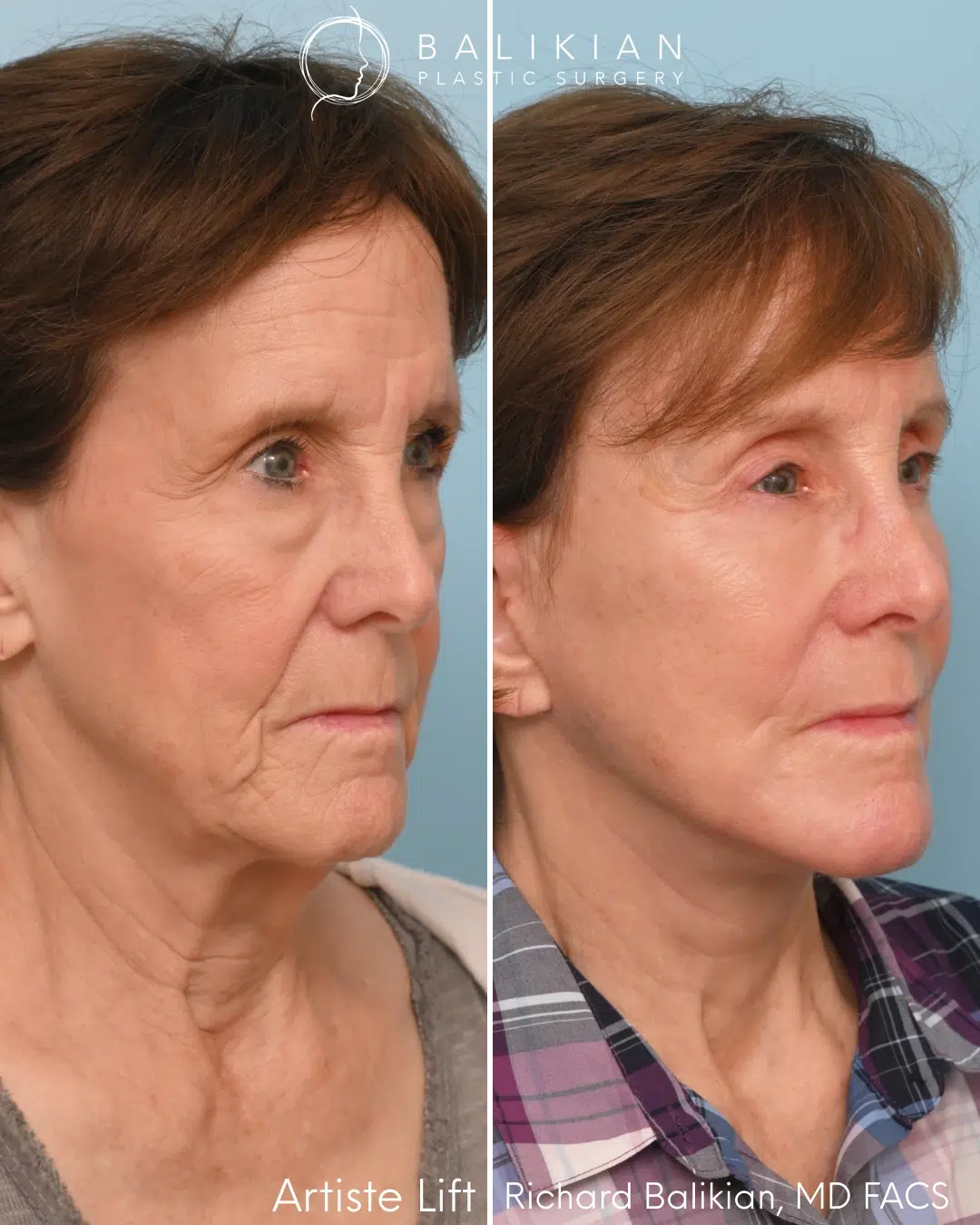 Oblique view before and after comprehensive facial rejuvenation.