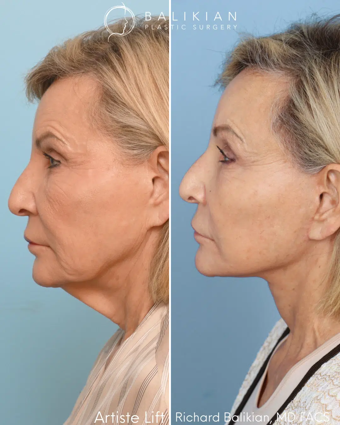 Profile view before and after facelift with neck and brow support.