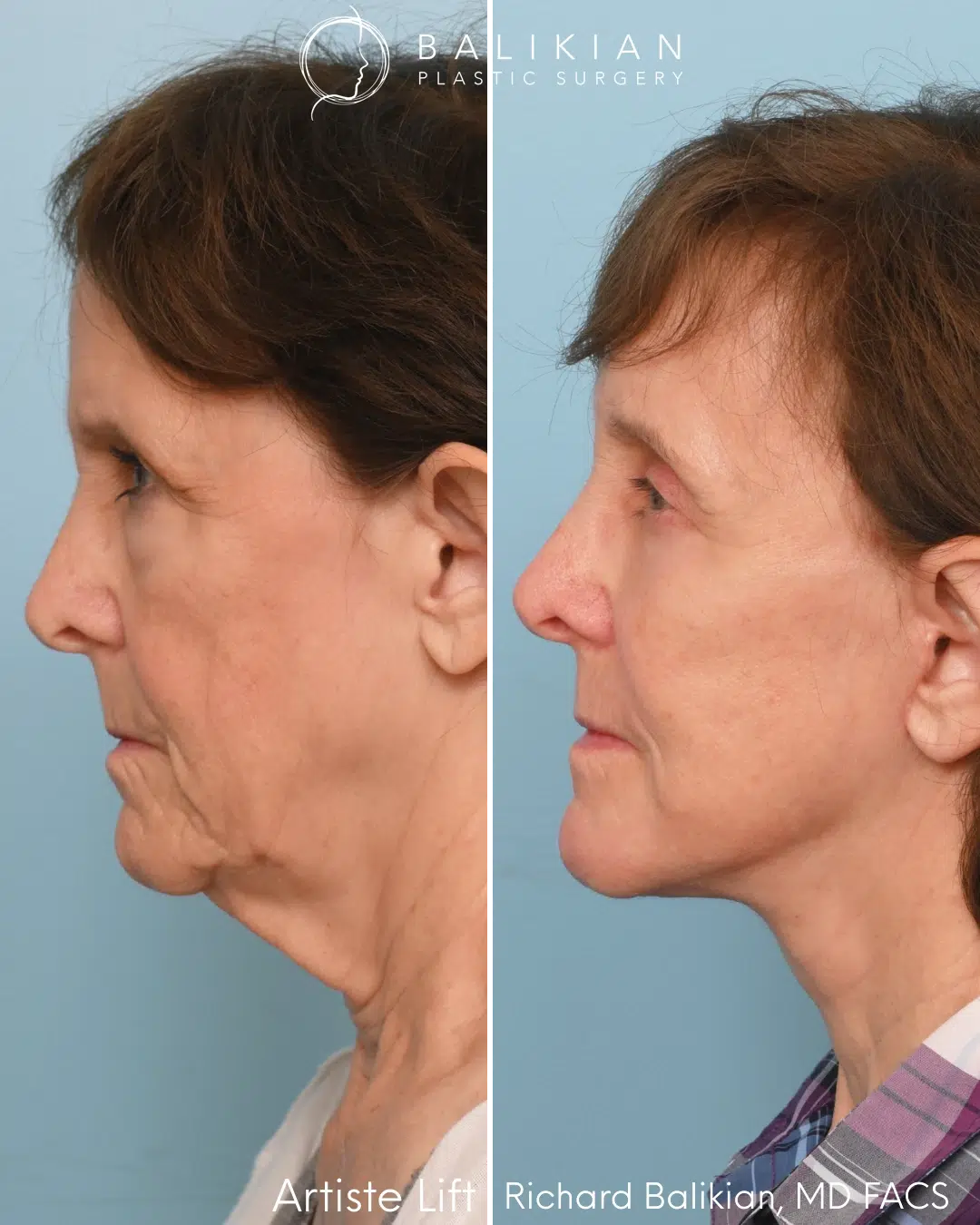 Profile view before and after deep plane facelift and neck lift.