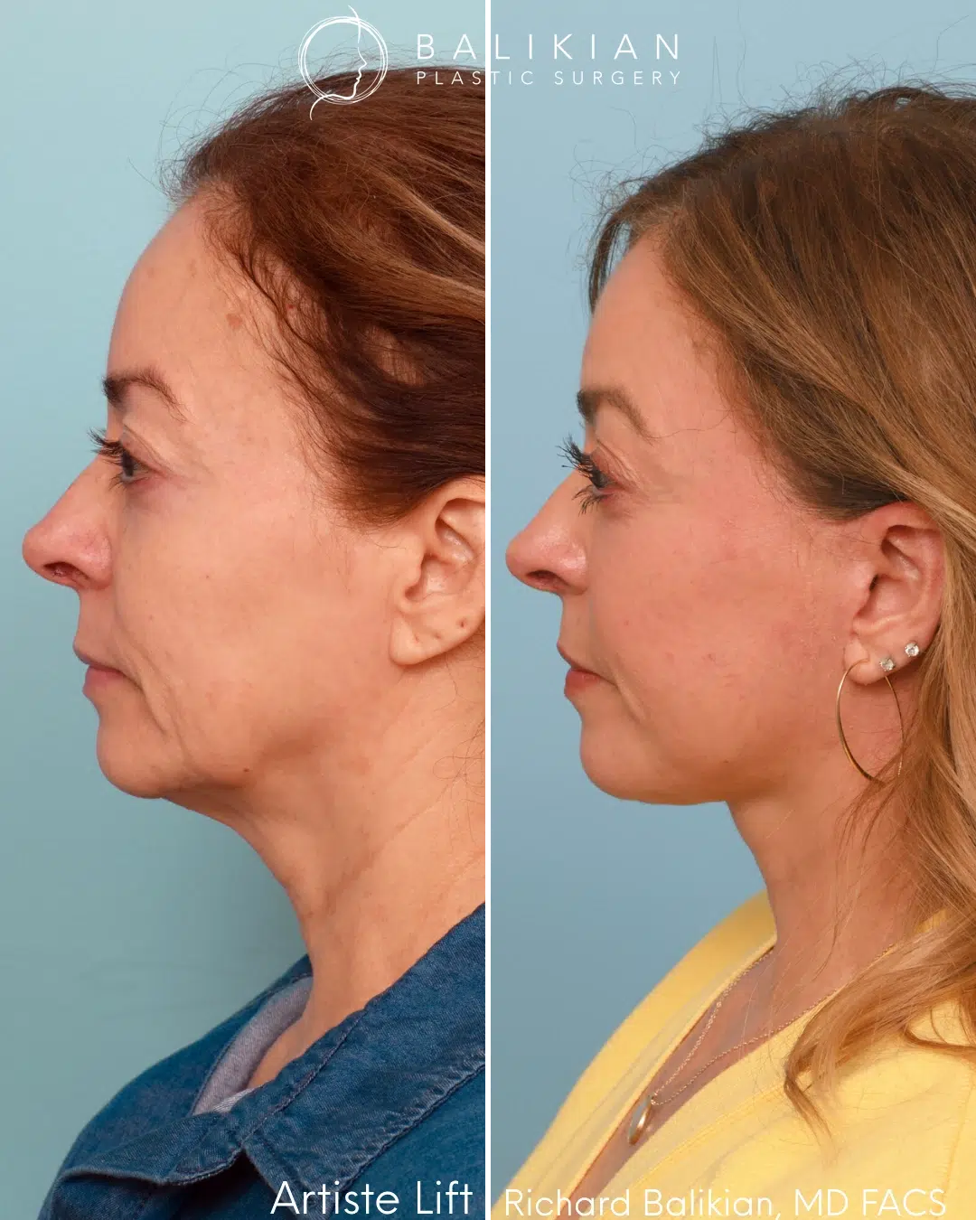 Profile view before and after facelift with neck refinement.