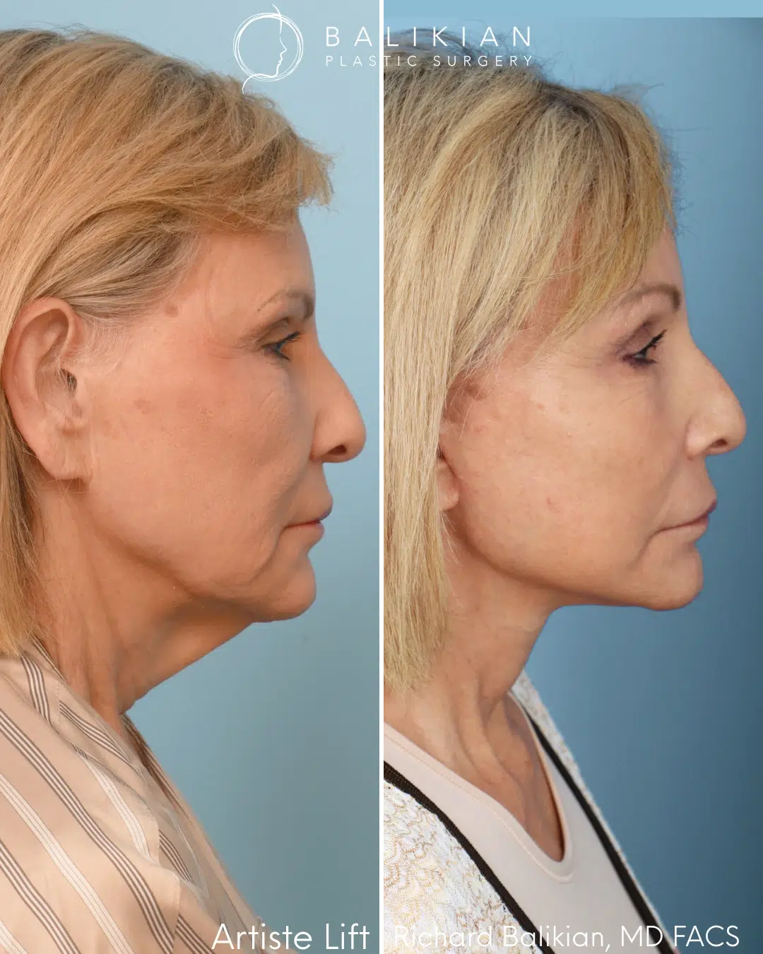 Profile view before and after facelift with neck and brow support.