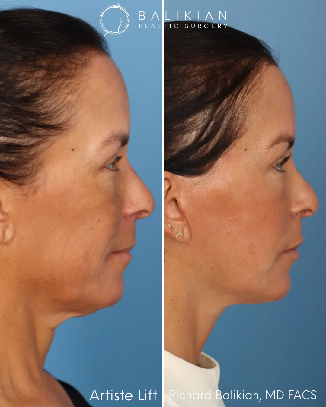 Profile view before and after deep plane facelift with neck contour improvement.