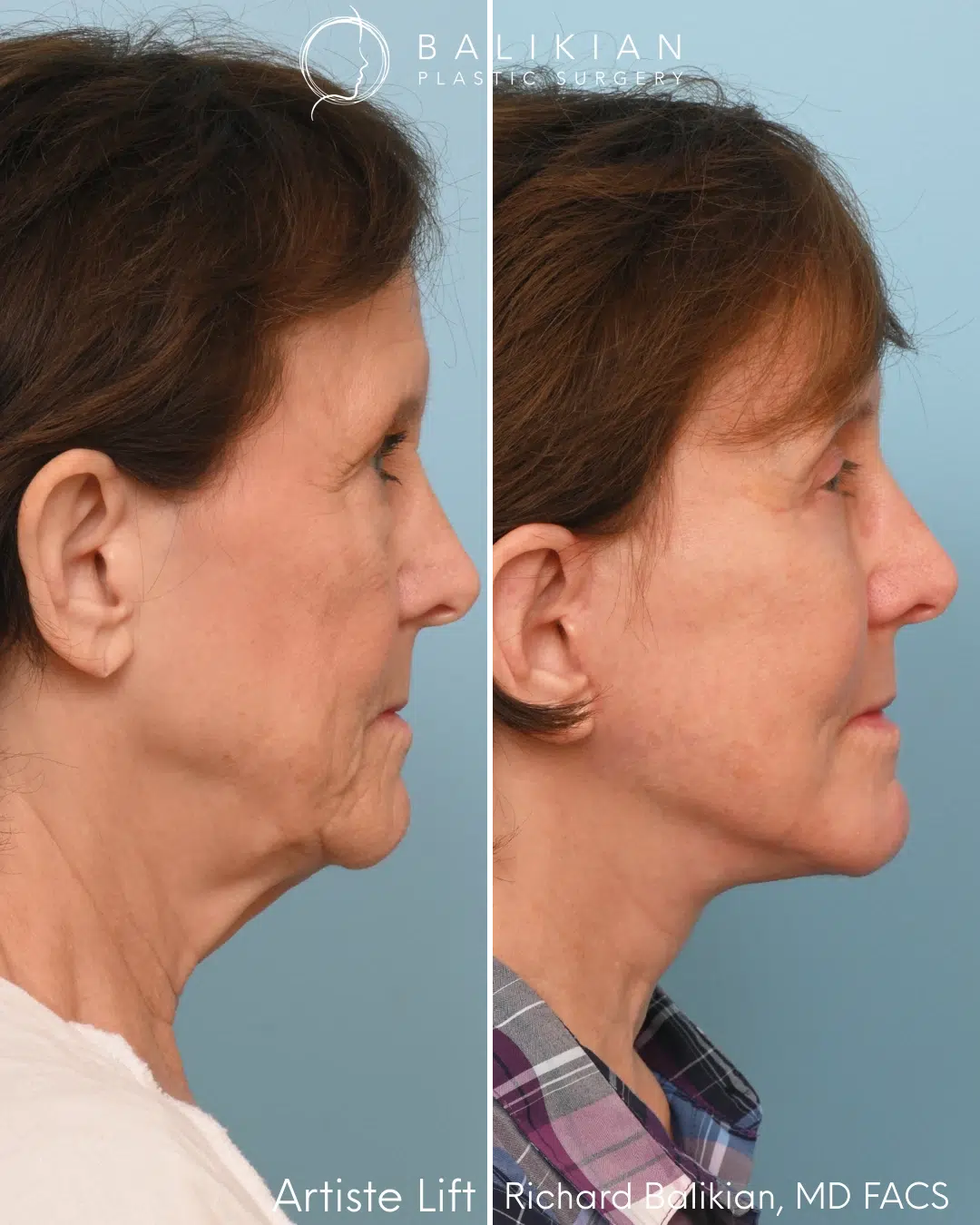 Profile view before and after deep plane facelift and neck lift.