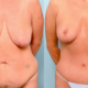 Before and after results of a mommy makeover showing breast lift and abdominal contouring following pregnancy