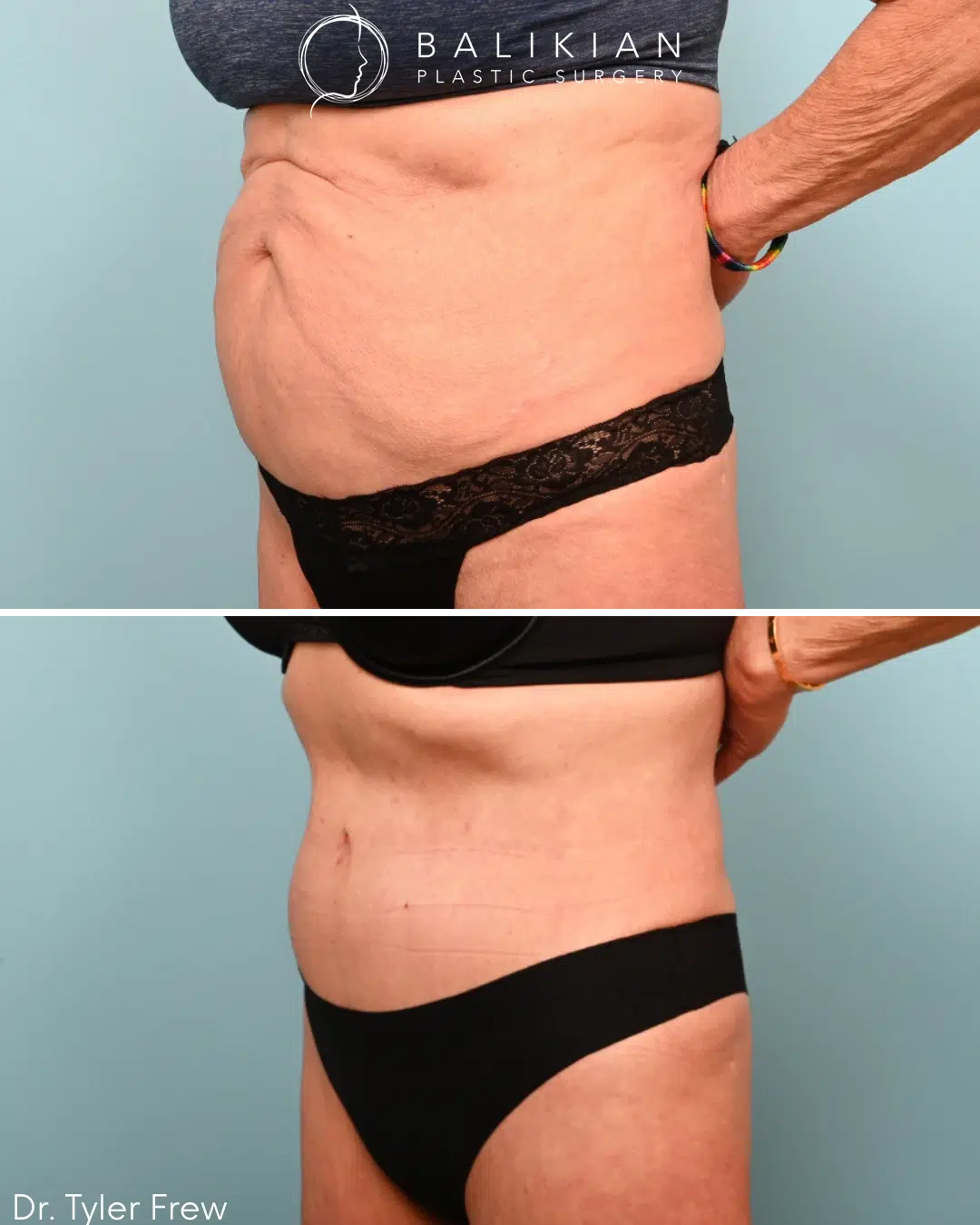 Left oblique view before and after tummy tuck demonstrating removal of loose abdominal skin and smoother contour after pregnancy and weight changes.