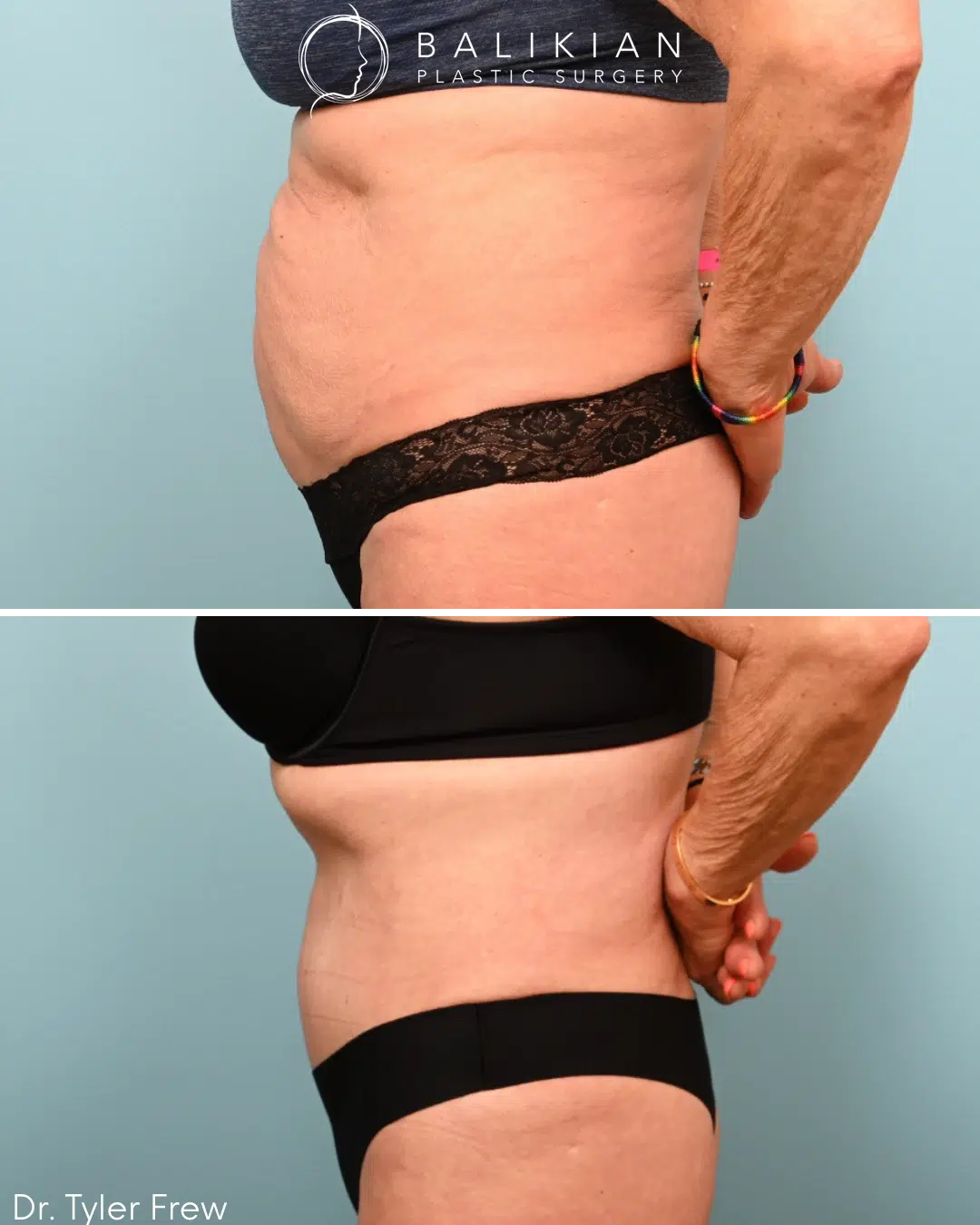 Left side profile before and after tummy tuck highlighting tighter abdominal profile and reduced fullness following abdominoplasty with liposuction.