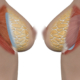 Breast implant placement diagram showing implants above the muscle (subglandular) and below the muscle (submuscular) in breast augmentation surgery