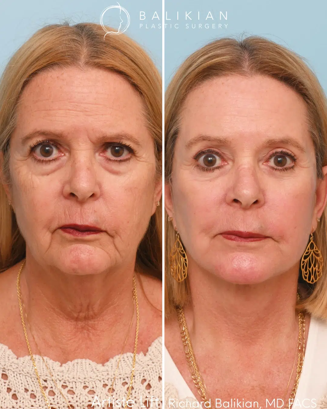 Frontal before and after deep plane facelift and eyelid surgery showing improved facial balance and smoother lower face.