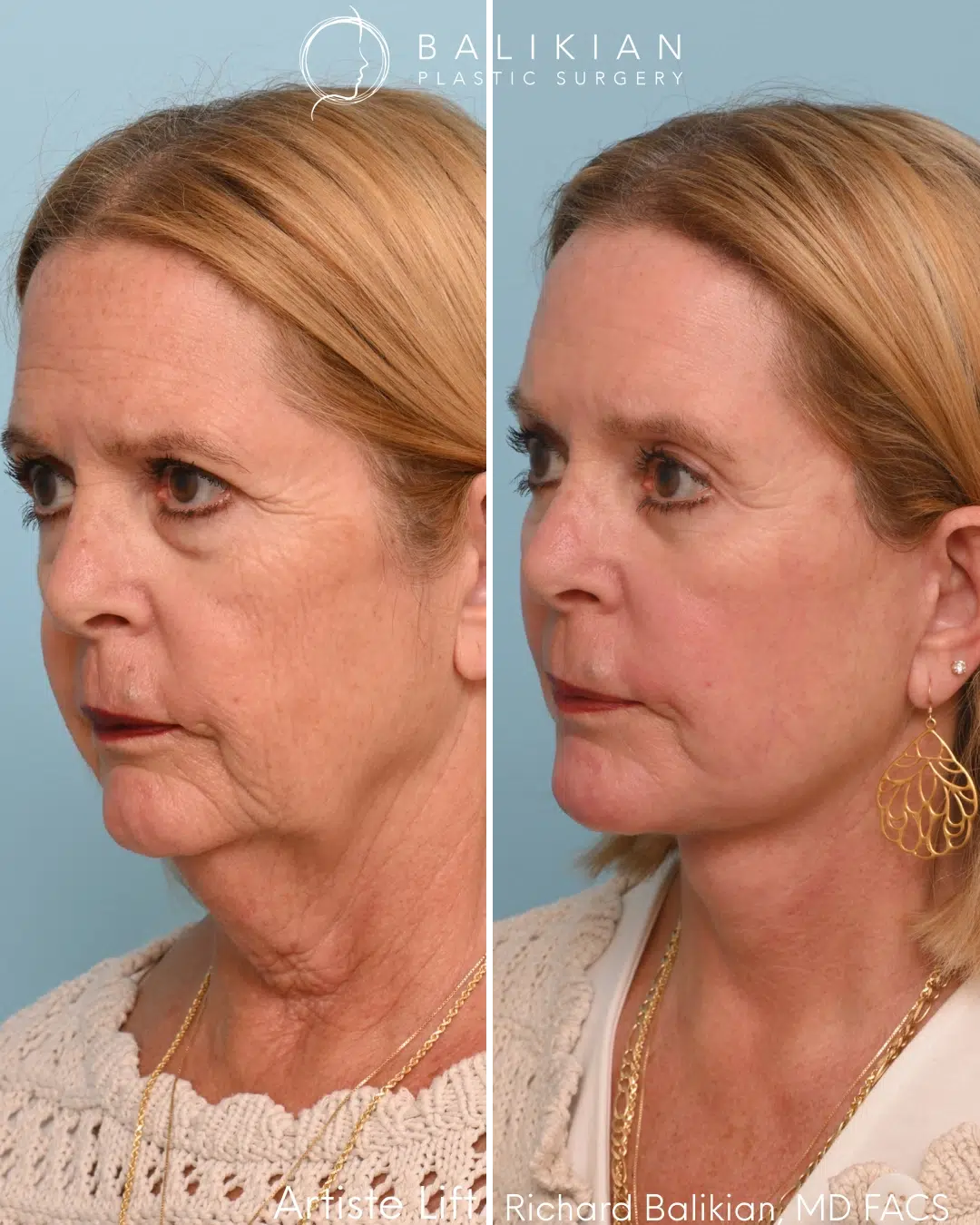 Left oblique before and after deep plane facelift and neck lift showing improved jawline contour and smoother facial transitions.