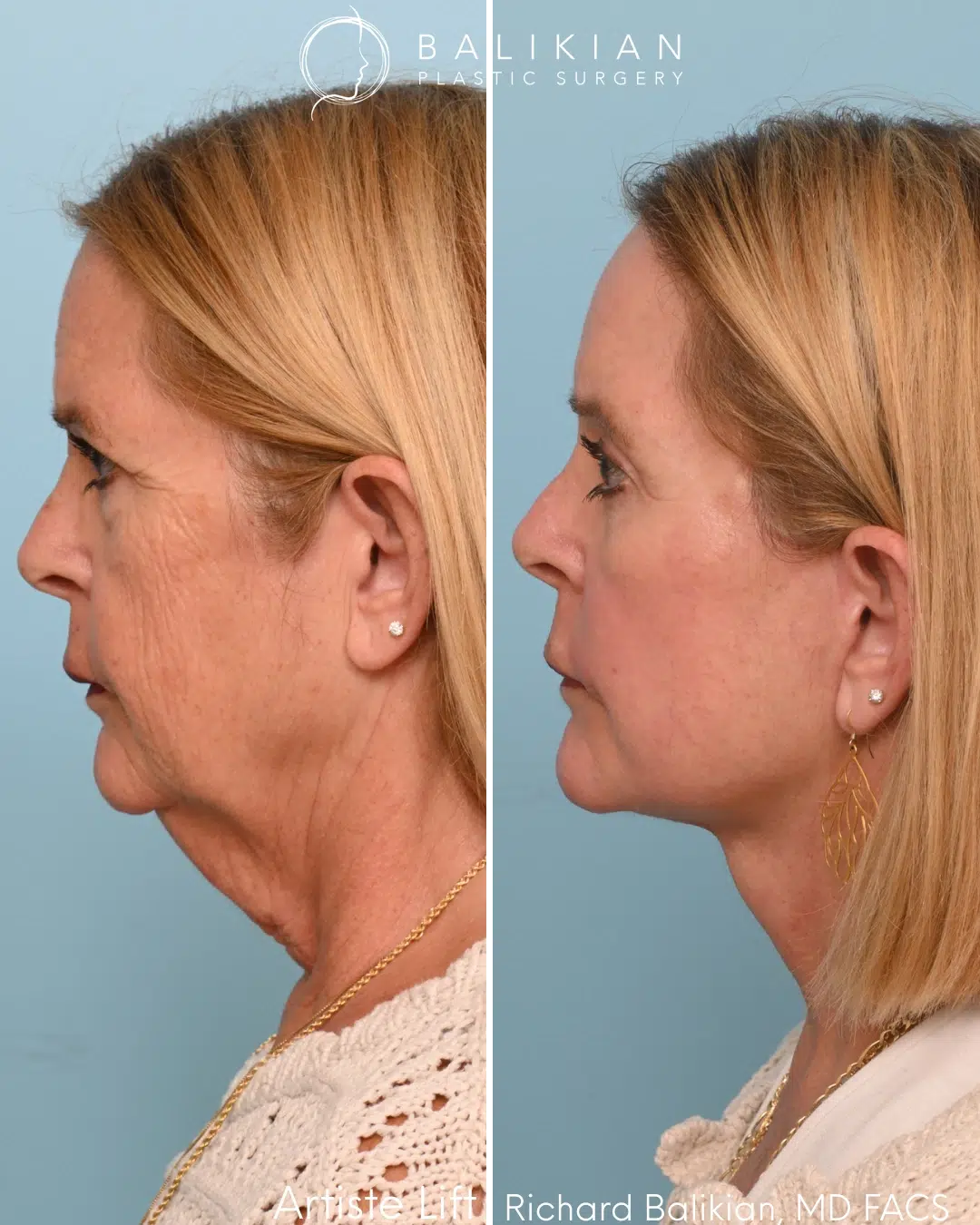 Left profile before and after deep plane facelift and neck lift showing refined jawline and reduced neck laxity.