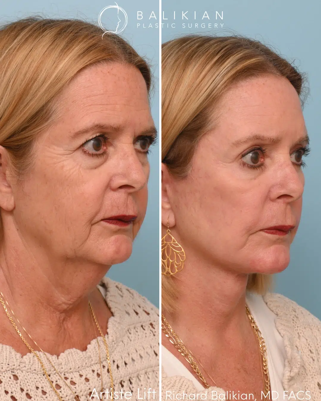 Right oblique before and after deep plane facelift and neck lift showing lifted facial contours and improved midface support.
