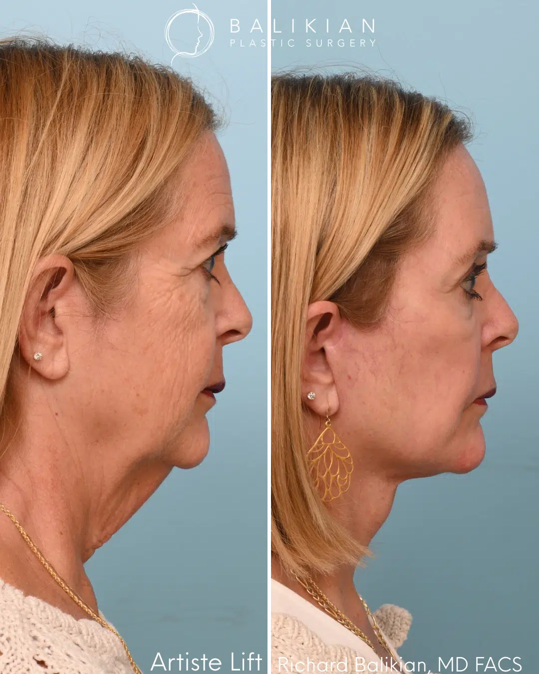 Right profile before and after deep plane facelift and neck lift showing improved jawline definition and smoother neck contour.