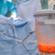 Liposuction procedure in operating room with surgical suction device collecting fat during body contouring surgery