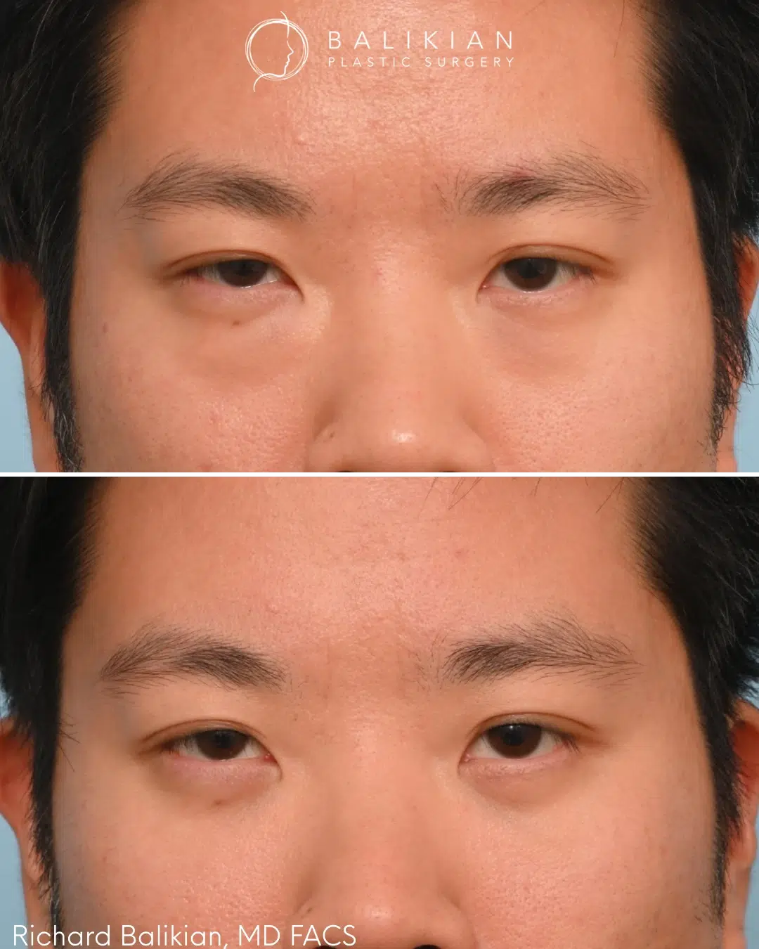40 year old male after lower blepharoplasty with fat transfer. Under eye fullness is reduced with a smoother, more refreshed appearance. Lower blepharoplasty before and after front view Asian male showing smoother under eye area and reduced puffiness