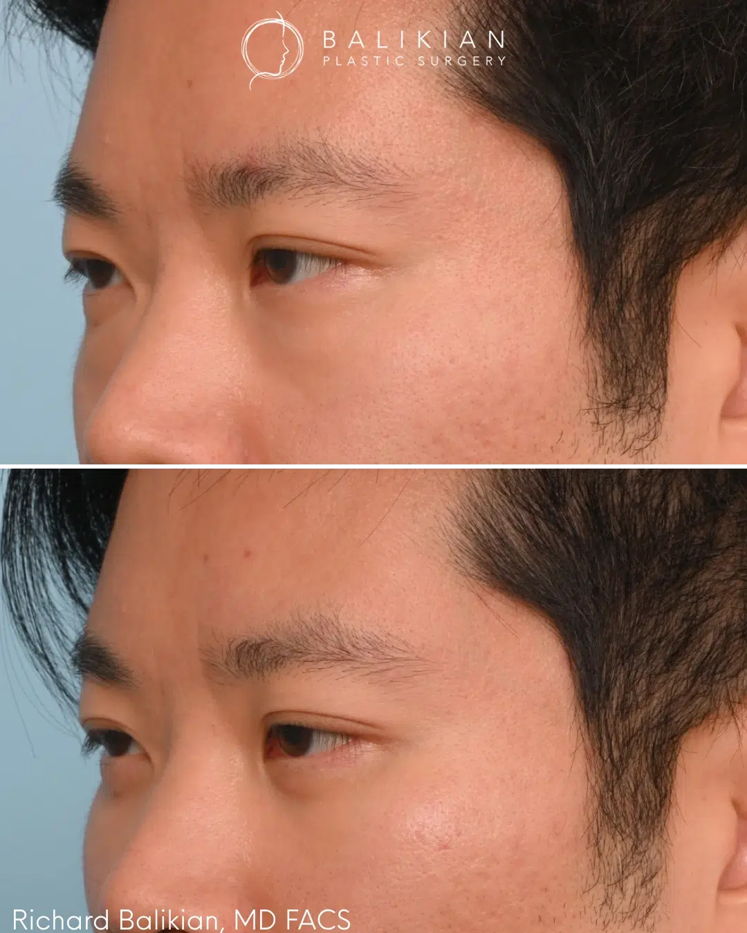 Left oblique view showing improved under eye contour and reduction in puffiness following lower eyelid surgery. Lower blepharoplasty before and after left oblique view Asian male improving under eye bags and contour