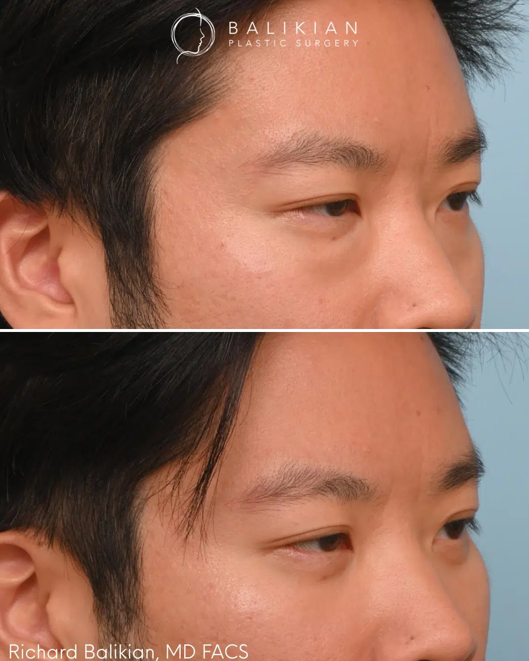 Right oblique view highlighting a more even under eye transition and natural result after lower blepharoplasty. Lower blepharoplasty before and after right oblique view Asian male with smoother under eye transition