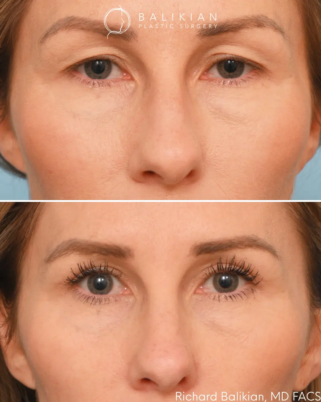 Upper blepharoplasty result with removal of excess eyelid skin, creating a more open and refreshed appearance. Upper blepharoplasty before and after front view showing improved eyelid definition and reduced excess skin