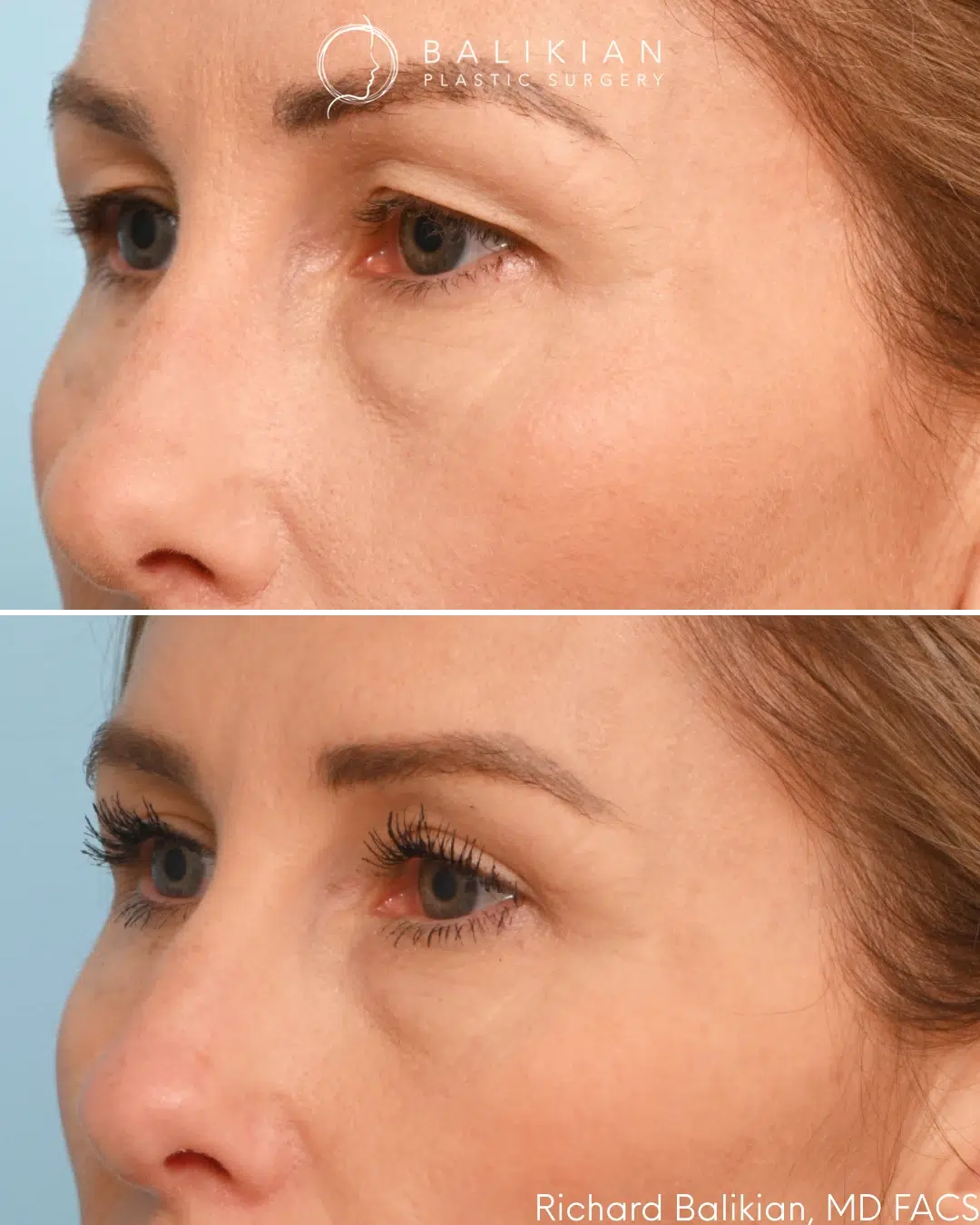 Left oblique view demonstrating improved upper eyelid contour and reduction in heaviness. Upper blepharoplasty before and after left oblique view showing smoother upper eyelid contour