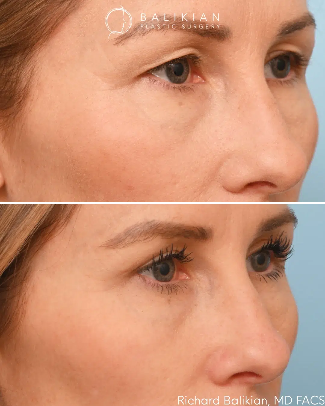 Right oblique view showing a cleaner eyelid crease and more defined upper eyelid after surgery. Upper blepharoplasty before and after right oblique view with enhanced eyelid definition
