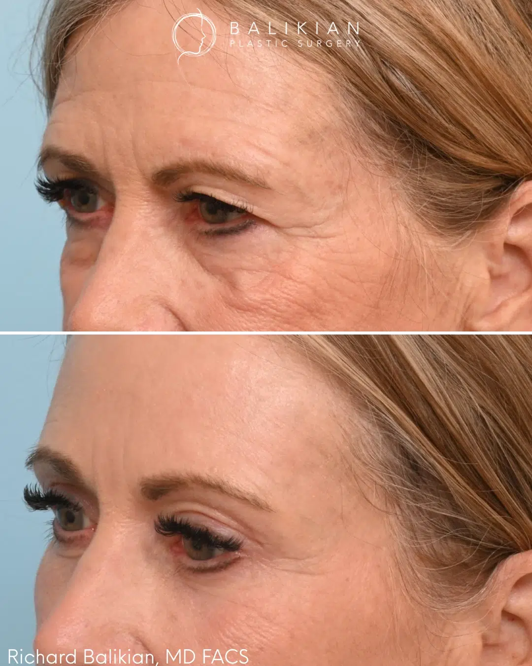 Left oblique view showing reduced under eye fullness and improved eyelid contour after surgery. Upper and lower blepharoplasty before and after left oblique view improving under eye bags and eyelid definition