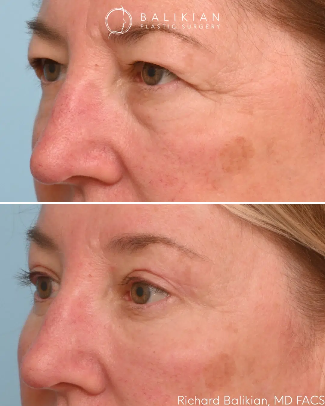 Left oblique view demonstrating reduced puffiness and improved upper and lower eyelid definition. Upper and lower blepharoplasty before and after left oblique view reducing under eye puffiness and excess skin