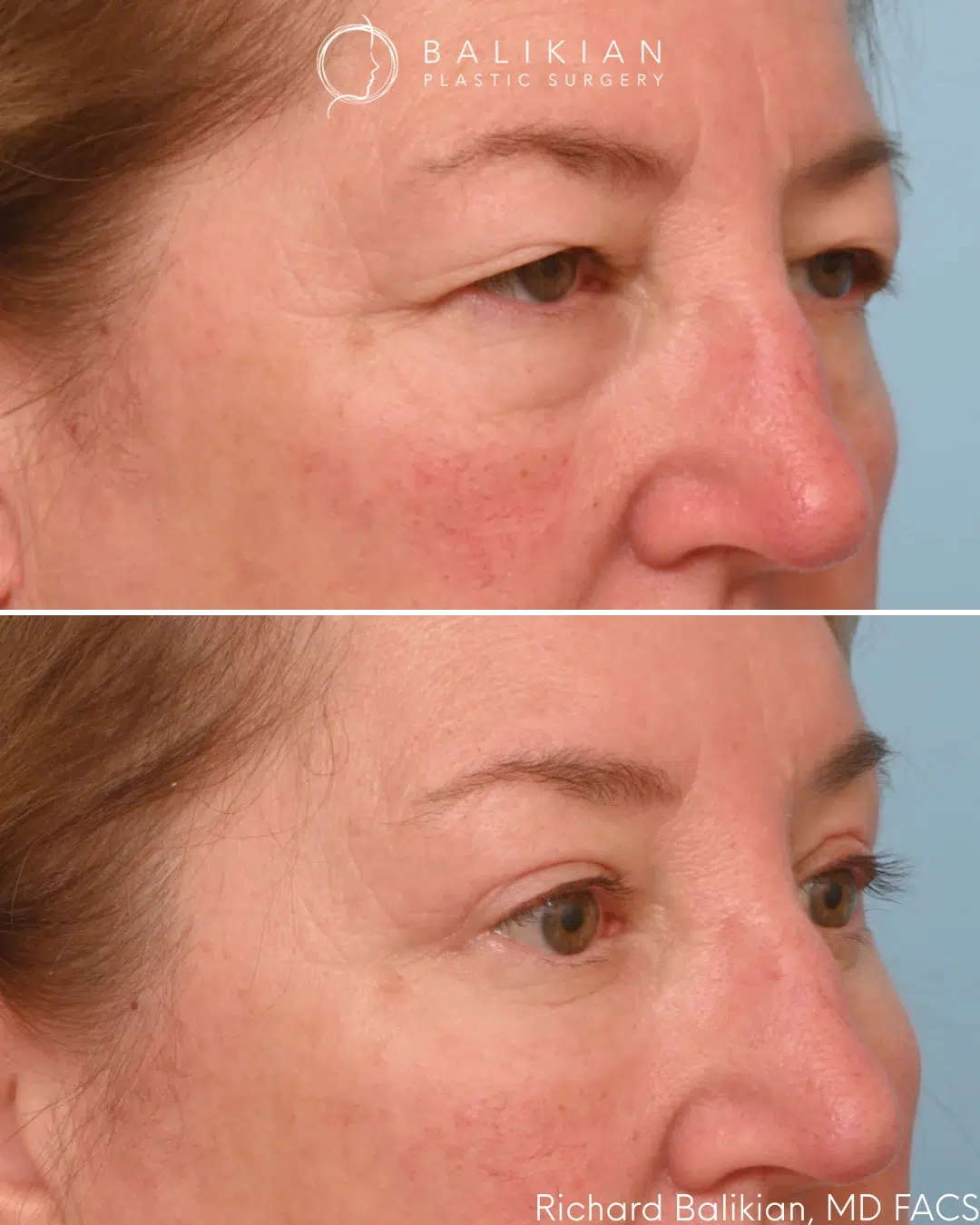 Right oblique view showing a more refined eyelid contour and natural, balanced result. Upper and lower blepharoplasty before and after right oblique view with refined eyelid contour