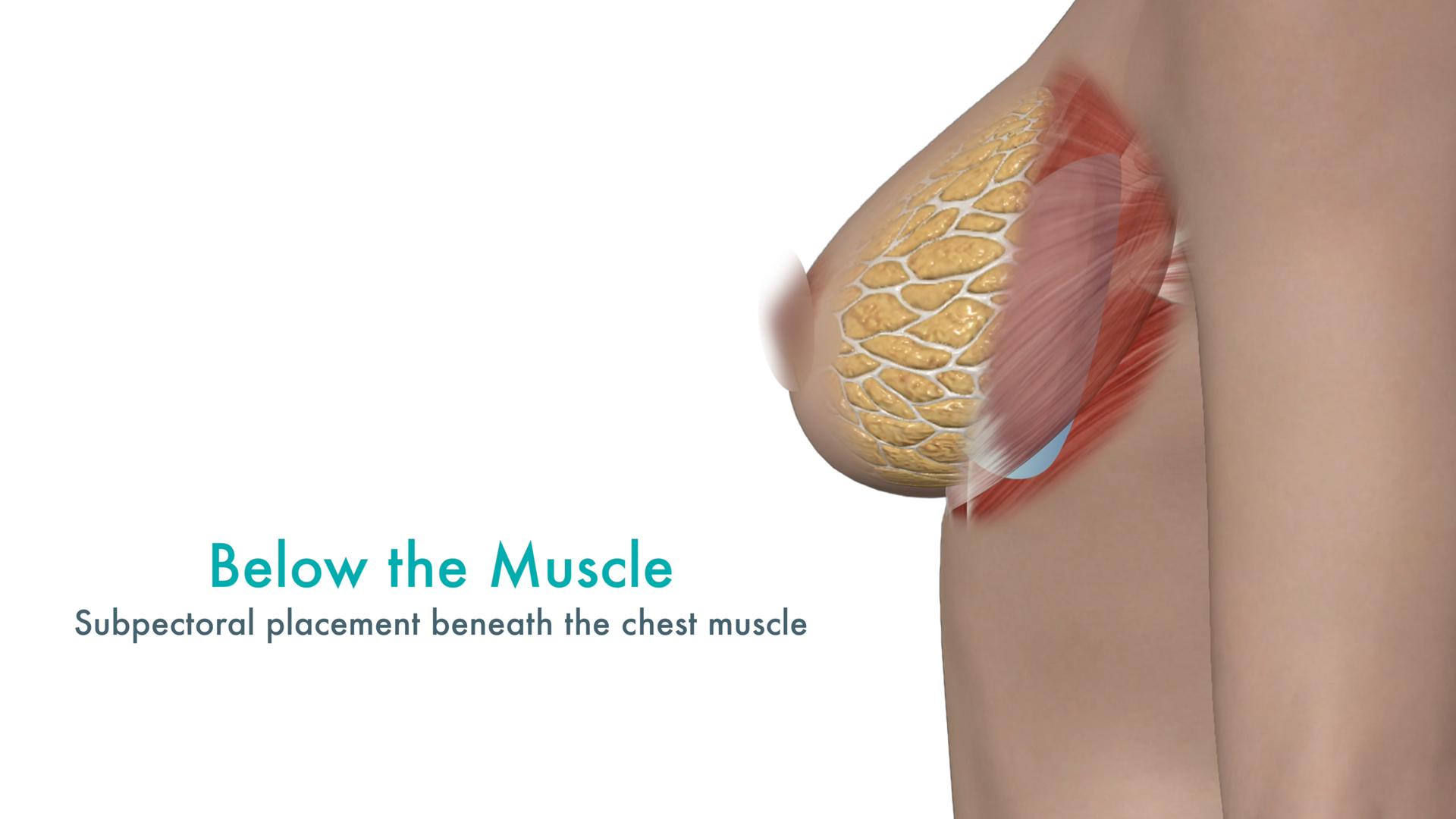 Medical illustration showing below-the-muscle breast implant placement beneath the pectoralis muscle during breast augmentation surgery