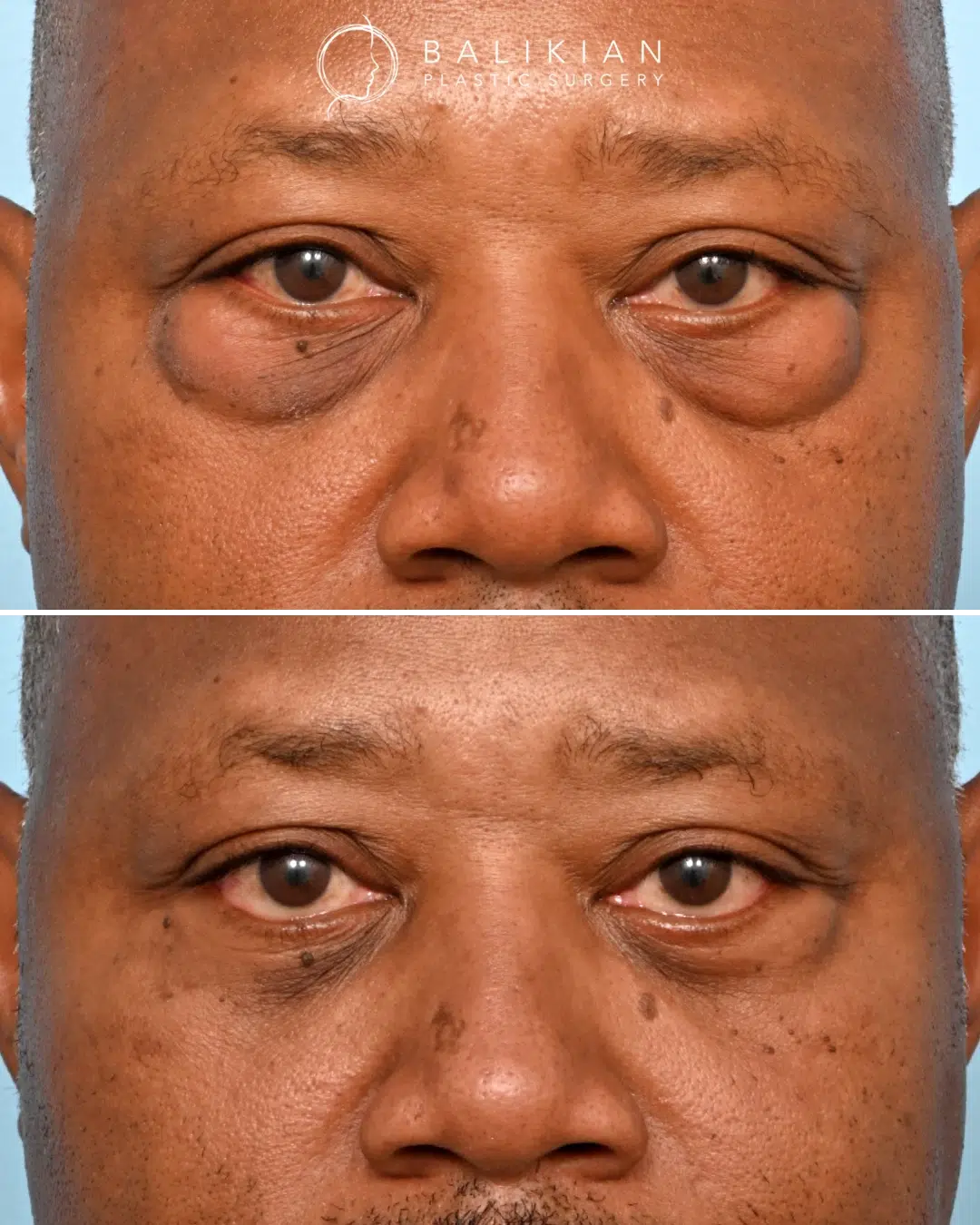 Before and after front view of a male patient after lower blepharoplasty combined with fat transfer. The results show reduced puffiness, softened under-eye shadows, and improved lower eyelid balance for a rested, youthful appearance that remains natural and masculine. Male lower blepharoplasty before and after front view showing natural reduction of under-eye bags and smoother lower eyelid contours with fat transfer.