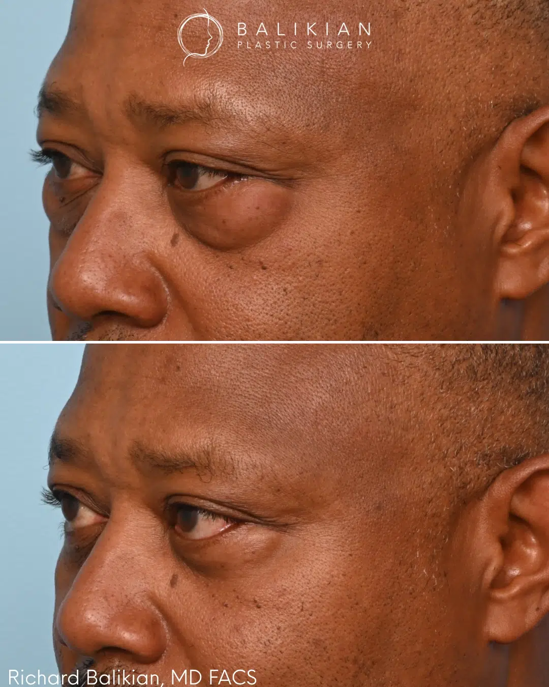 Before and after left oblique view of a male patient treated with lower eyelid surgery and targeted fat transfer. By restoring volume beneath the eyes, the procedure softened hollow areas and created a brighter, more refreshed appearance while preserving natural facial character. Male lower blepharoplasty before and after left oblique view highlighting improvement in under-eye hollows, reduced puffiness, and smoother lower eyelid contours after fat transfer.