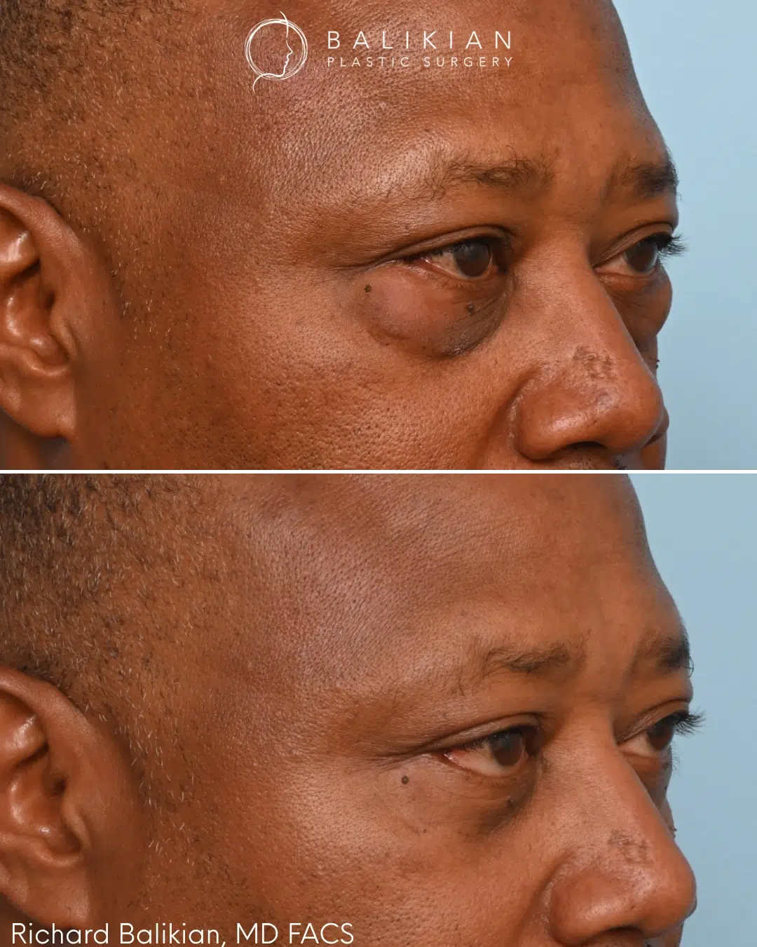 Before and after right oblique view of a male patient following lower blepharoplasty with precise fat transfer. The procedure reduced under-eye puffiness and softened dark shadows while restoring smoother, more youthful lower eyelid contours without changing his natural appearance. Male lower blepharoplasty before and after right oblique view showing reduced under-eye bags, smoother tear trough contours, and improved lower eyelid definition after fat transfer.